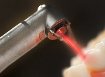 лазерная имплантация зубов